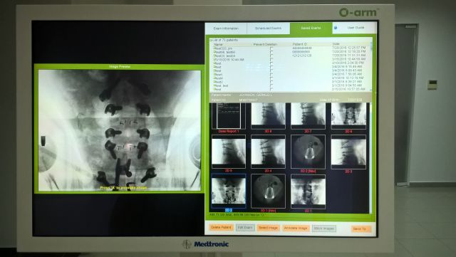 MEDTRONIC OARM Surgical Navigation System