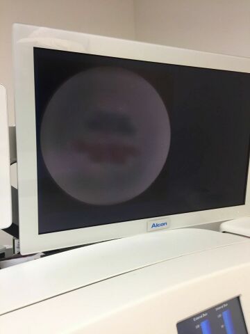 ALCON LenSx Laser - Femto